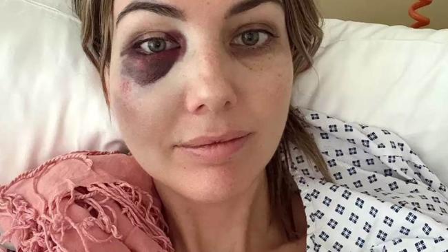 Miracle at 35,000 Feet: A Young Woman's Near-Fatal Blood Clot Incident Highlights In-Flight Health Risks